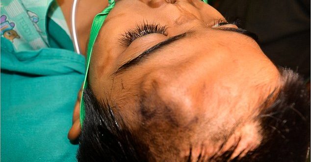 Индийские врачи пересадили пациенту нос, предварительно вырастив его на лбу